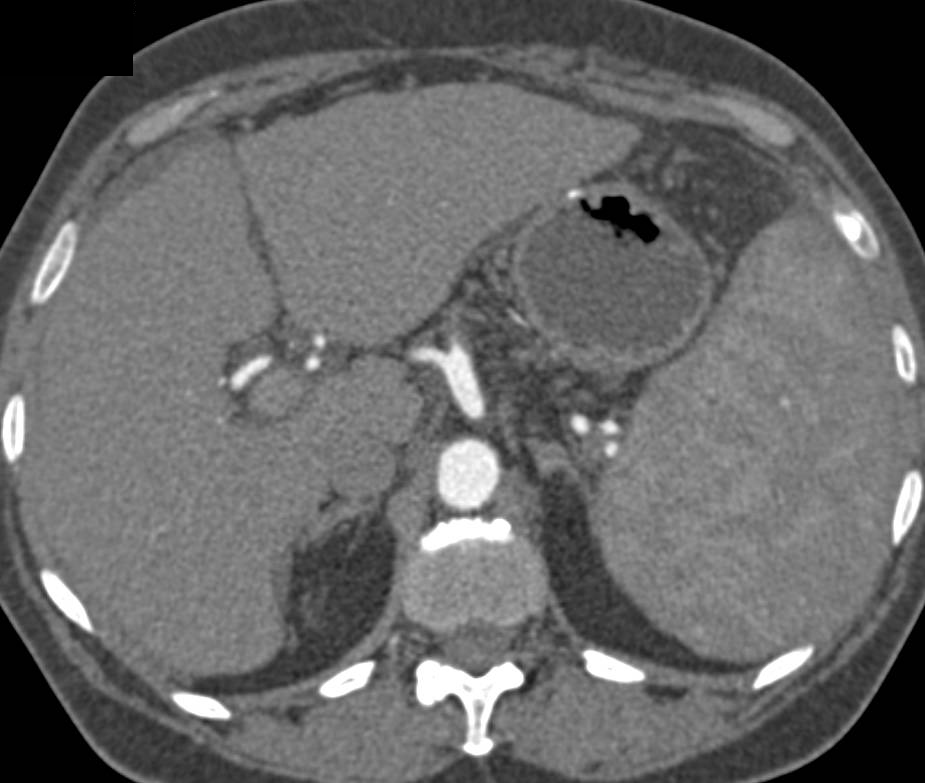 Cirrhosis with Portal Hypertension - CTisus CT Scan