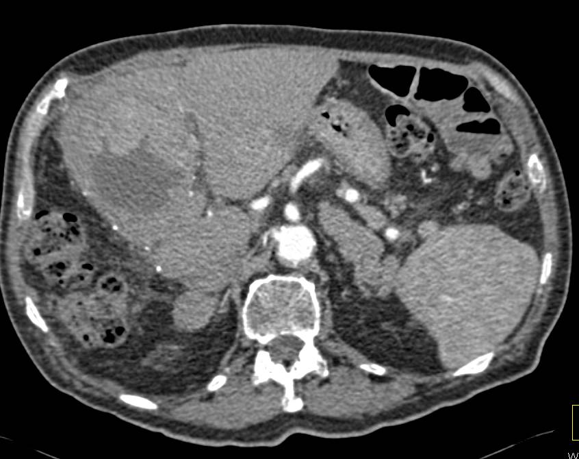 Recurrent Hepatocellular Carcinoma (Hepatoma) s/p Resection - CTisus CT Scan