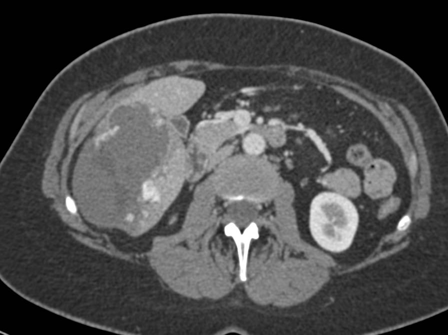 Giant Cavernous Hemangioma - CTisus CT Scan