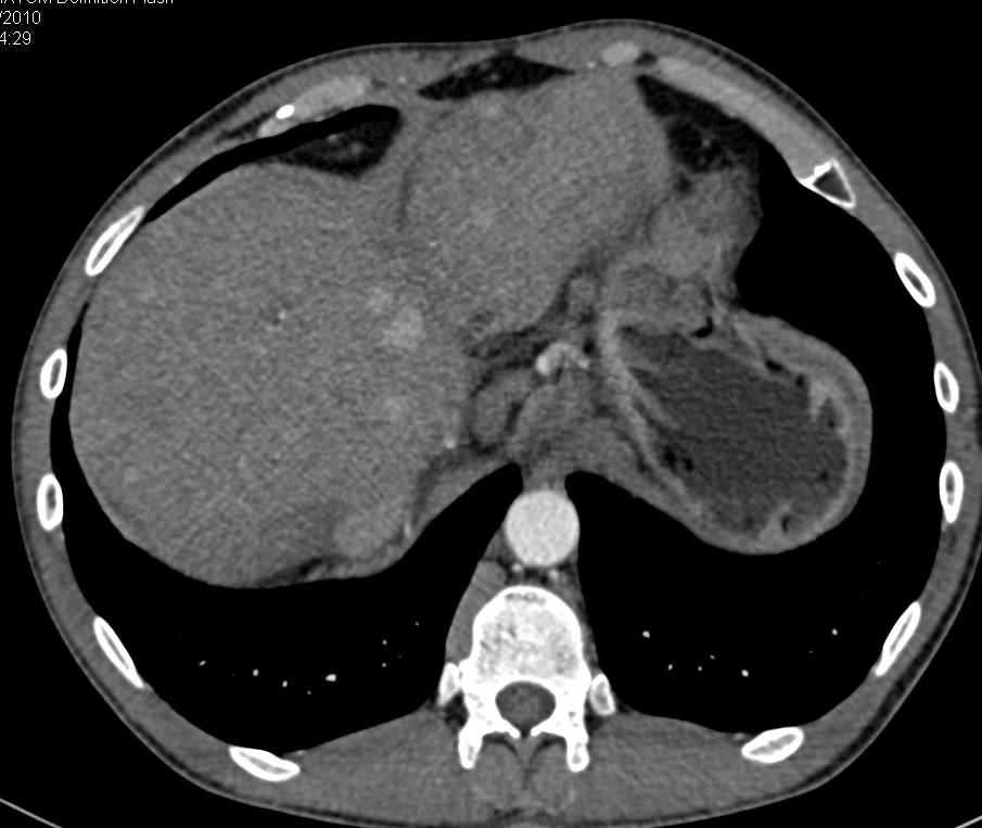 Metastatic Neuroendocrine Tumor to the Liver - CTisus CT Scan