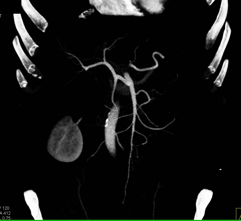 Ampullary Carcinoma with a Double Duct Sign - CTisus CT Scan