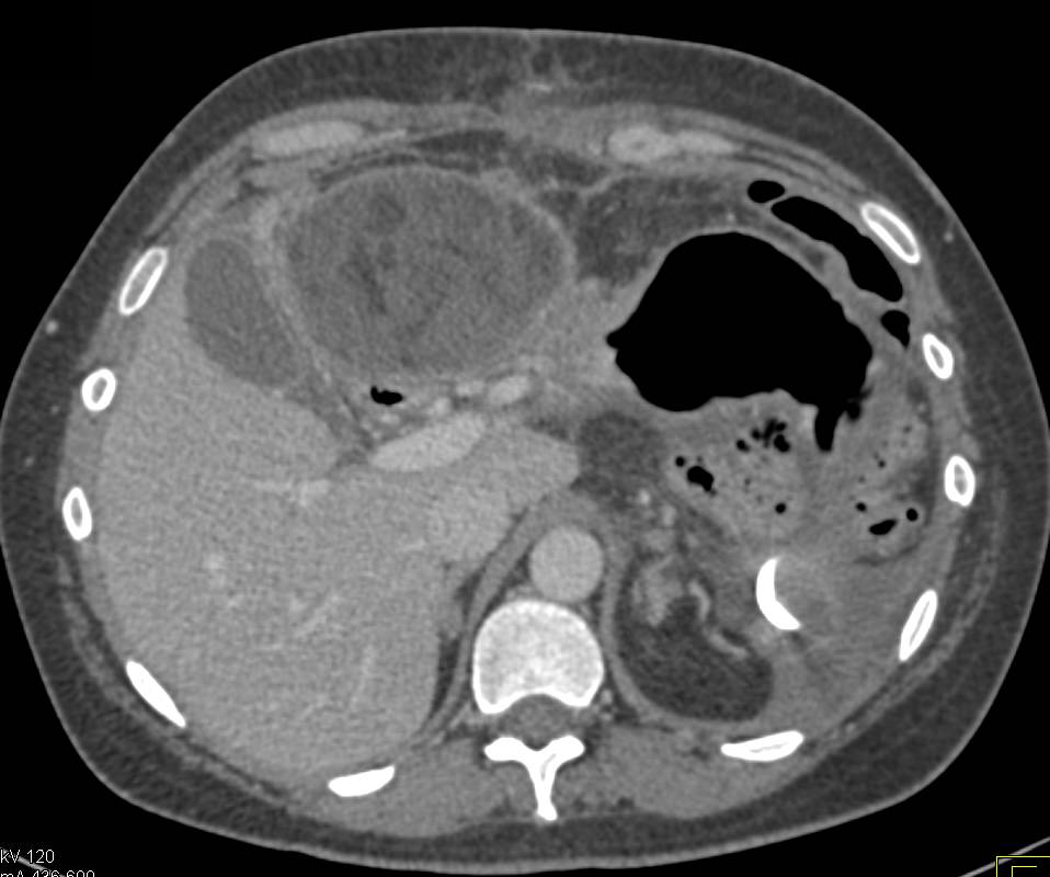 Abscess with Inflamed Mesentery Near Left Lobe Liver - CTisus CT Scan