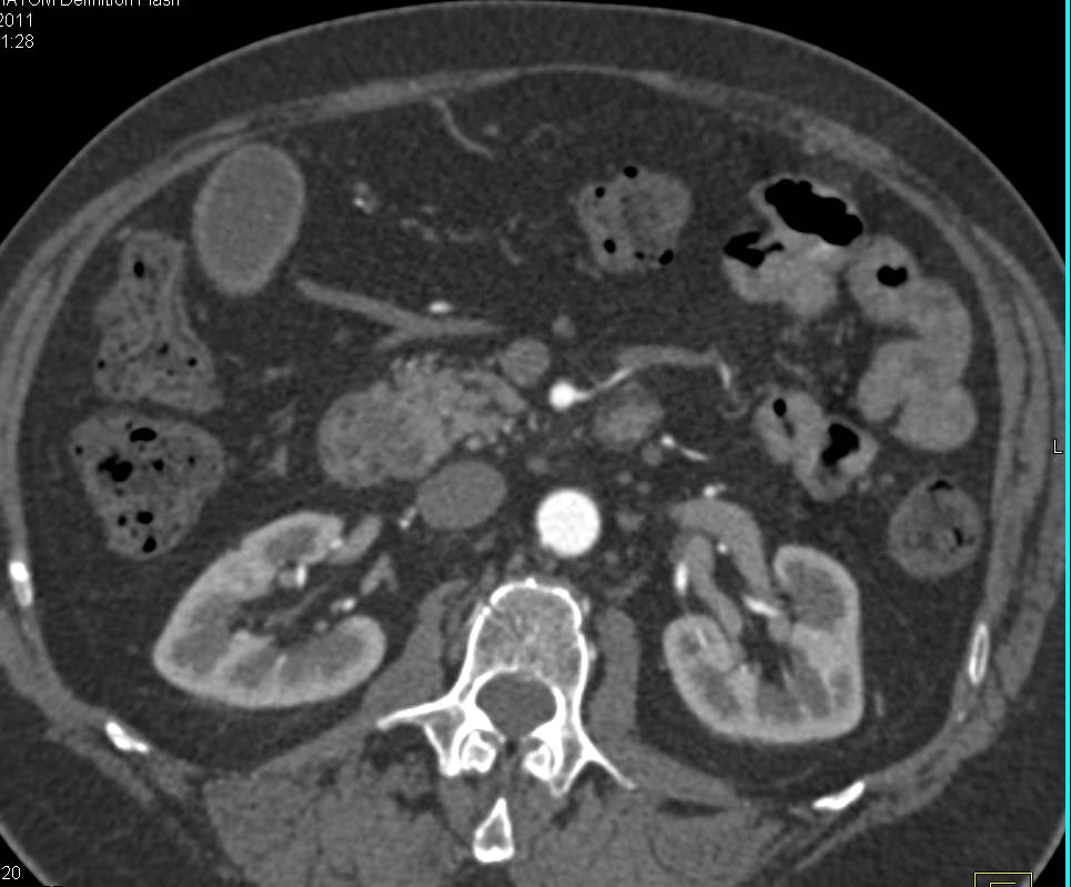 Ampullary Carcinoma - CTisus CT Scan