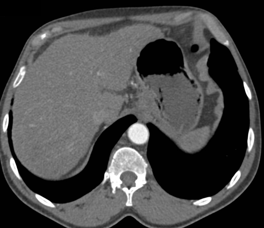 Hepatocellular Carcinoma (Hepatoma) with Neovascularity Arises in a Cirrhotic Liver - CTisus CT Scan