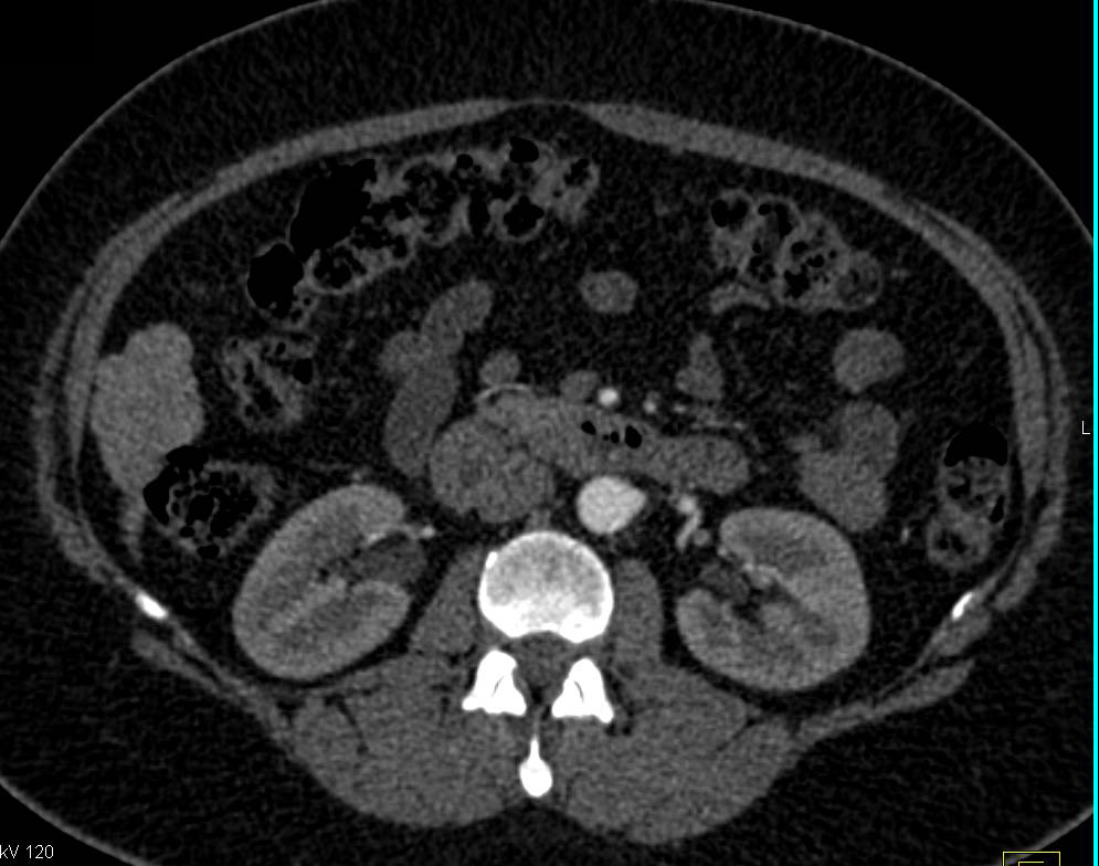 Focal Nodular Hyperplasia (FNH) Hangs off the Right Lobe of the Liver - CTisus CT Scan