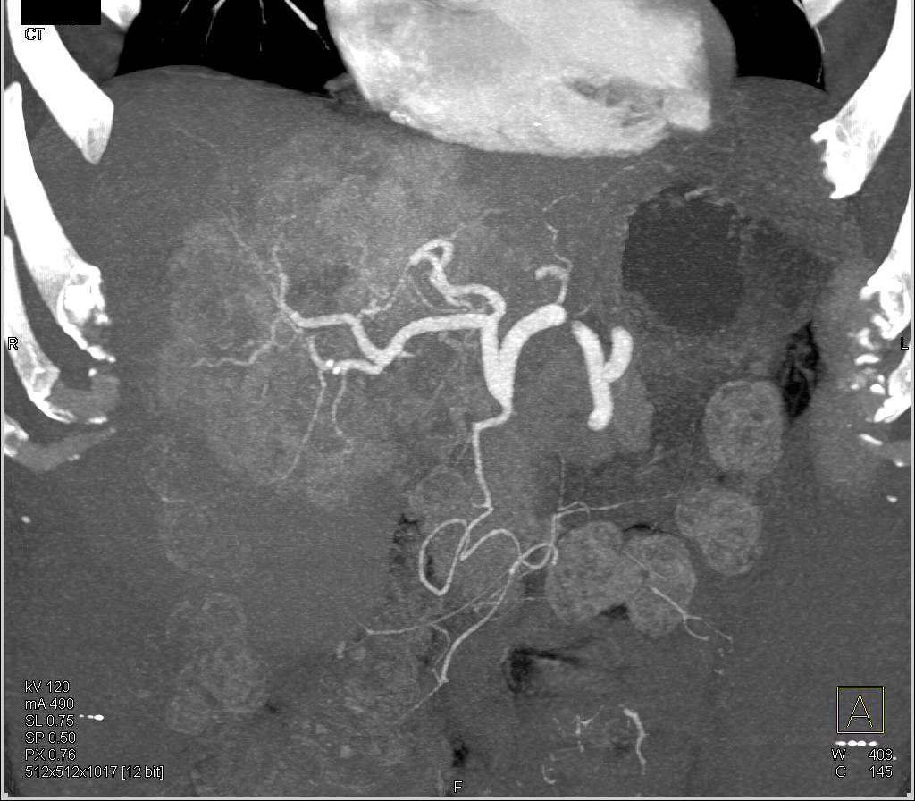 Intrahepatic Cholangiocarcinoma - CTisus CT Scan