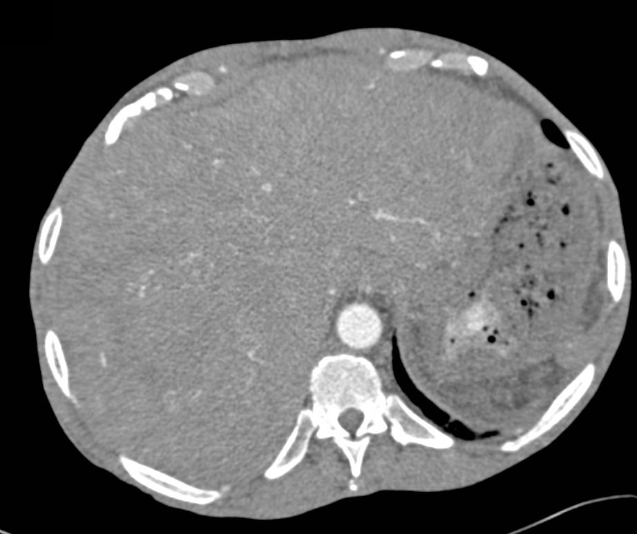 Infiltrating Hepatocellular Carcinoma (Hepatoma) Invades the Portal Vein with Impressive Collaterals Seen with Neovascularity - CTisus CT Scan