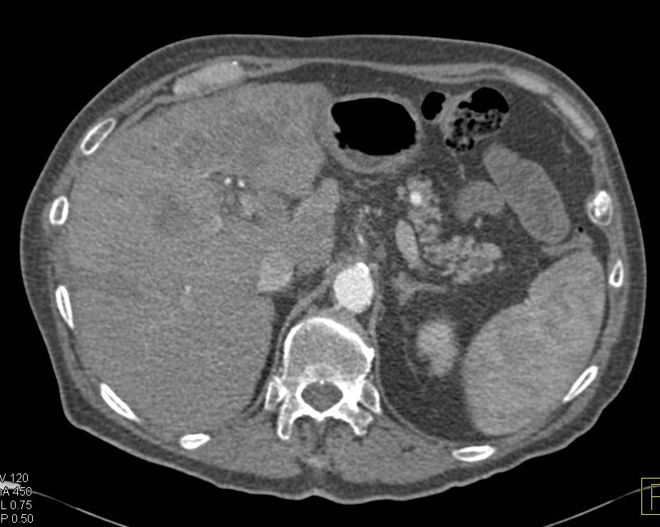 Liver Metastases with Peripancreatic Adenopathy - CTisus CT Scan