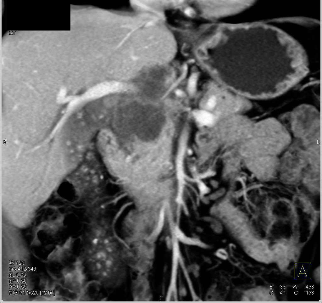 Ampullary Carcinoma and Gallstones - CTisus CT Scan