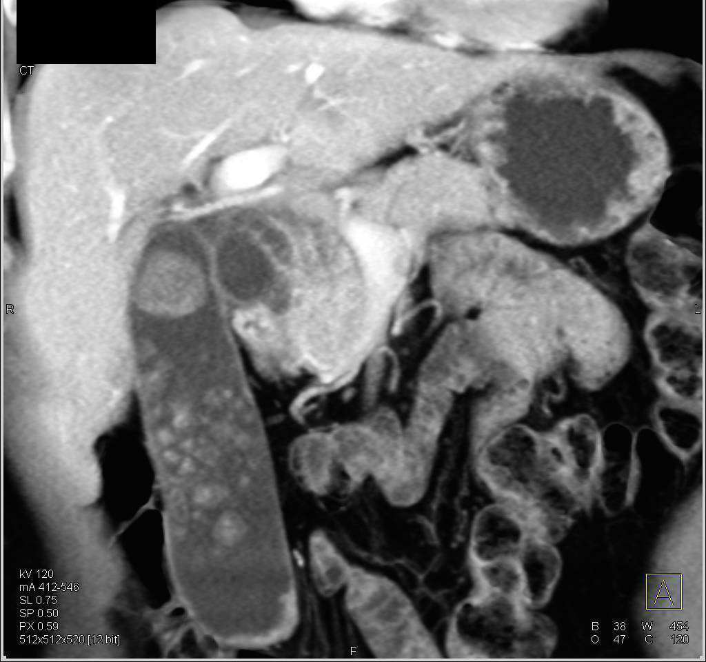 Distal Common Bile Duct Tumor with Nodes and Gallstones in a Distended Gallbladder - CTisus CT Scan