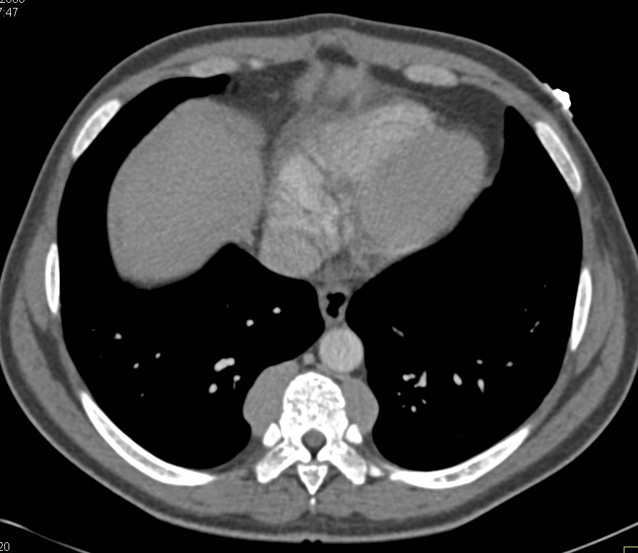 Extramedullary Hematopoesis - CTisus CT Scan