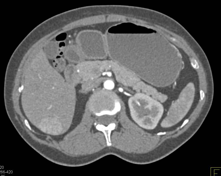 Focal Nodular Hyperplasia (FNH) Right Lobe of the Liver - CTisus CT Scan
