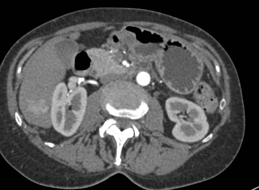 Focal Nodular Hyperplasia (FNH) in Right Lobe of the Liver - CTisus CT Scan
