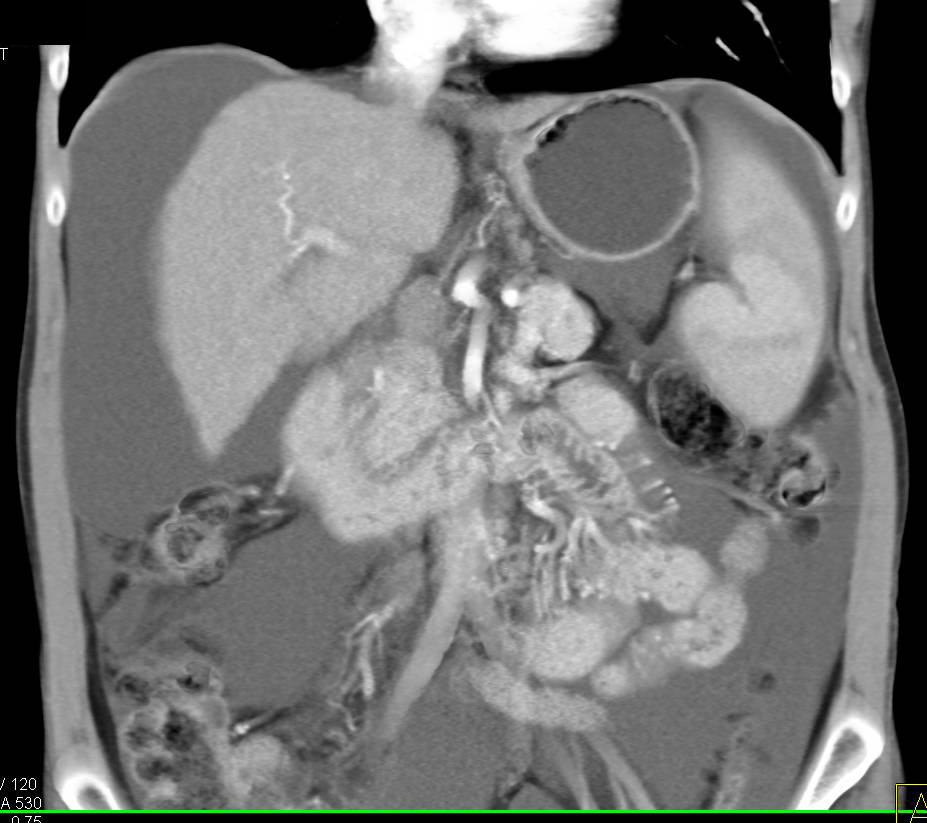 Recanalization of Umbilical Vein in a Cirrhotic Liver - CTisus CT Scan