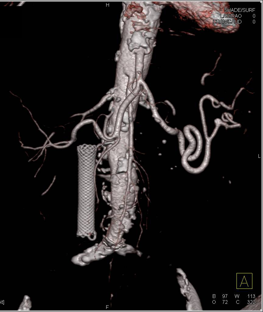 Wall Stent in the Common Bile Duct - CTisus CT Scan