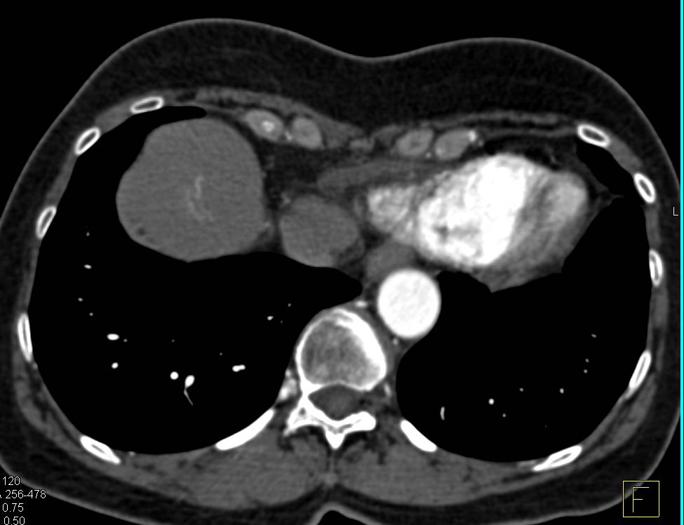 Subtle Hepatocellular Carcinoma (Hepatoma) in the Dome of the Liver - CTisus CT Scan