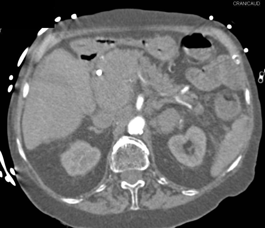 Gallbladder Cancer with Extensive Periportal Nodes - CTisus CT Scan