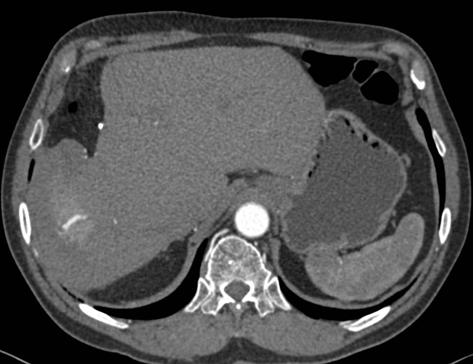 Recurrent Hepatocellular Carcinoma (Hepatoma) with CTA - CTisus CT Scan