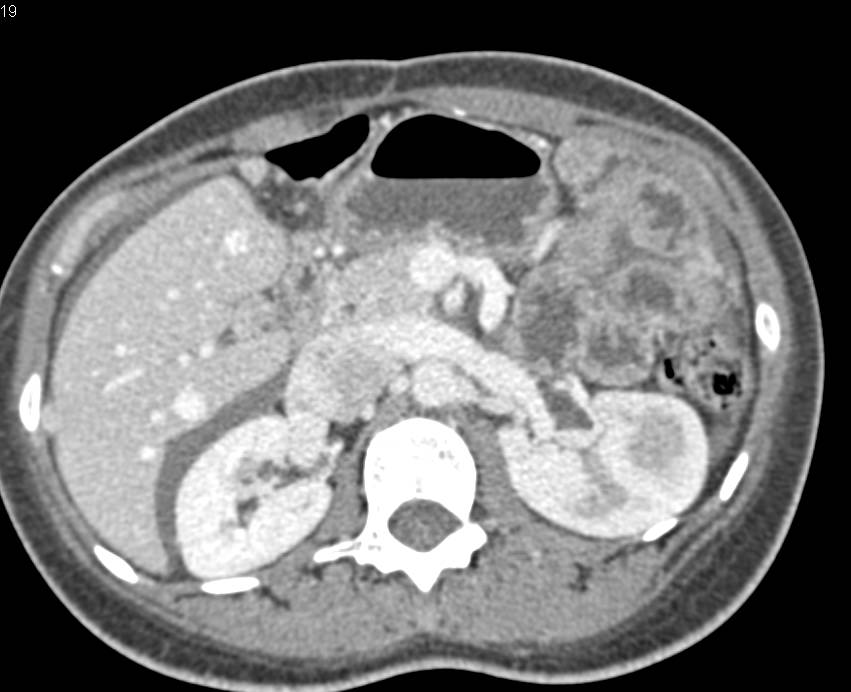 Recurrent Fibrolamellar Hepatocellular Carcinoma (Hepatoma) with Ascites and Subtle Implants - CTisus CT Scan