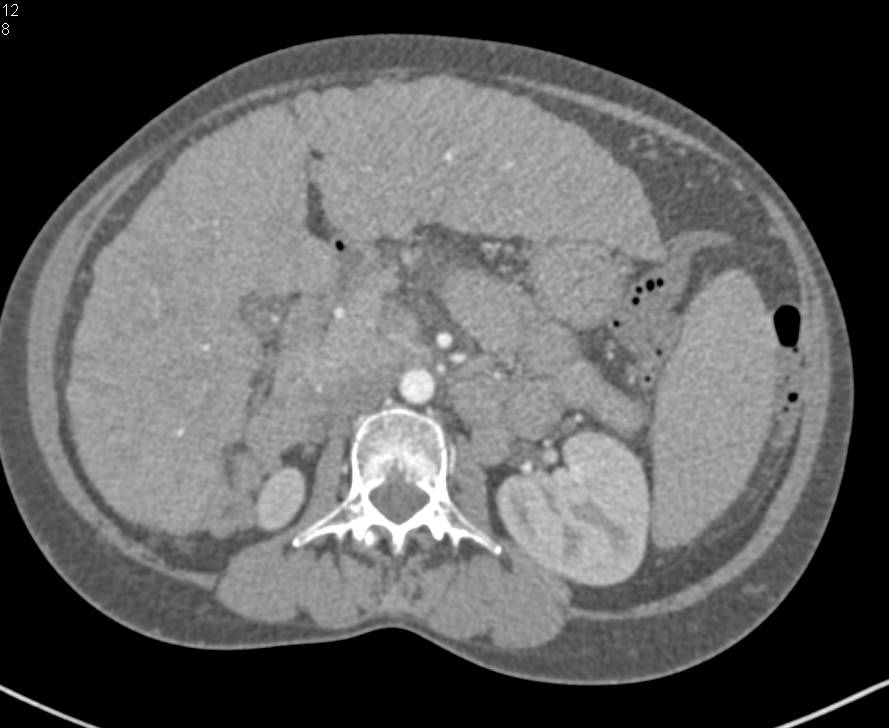 1 cm Hepatocellular Carcinoma (Hepatoma) in a Cirrhotic Liver with Portal Hypertension and Varices. Key is Arterial Phase - CTisus CT Scan