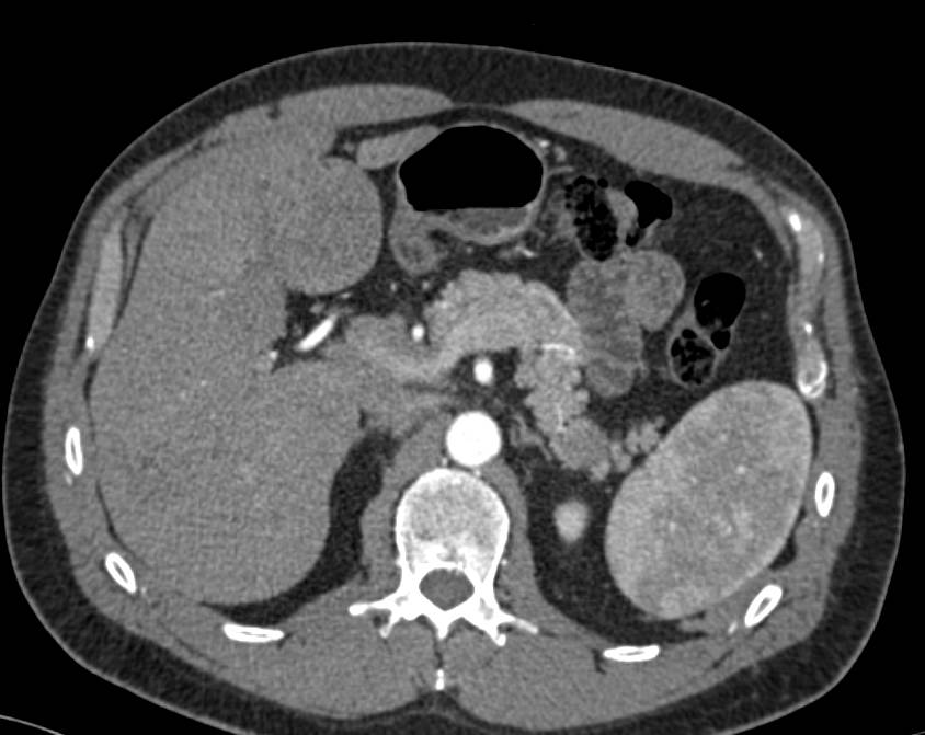 Unusual Neuroendocrine Tumor of the Tail of the Pancreas with Liver Metastases - CTisus CT Scan
