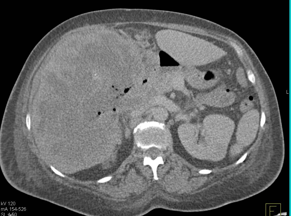 Hepatocellular Carcinoma (Hepatoma) with Necrosis - CTisus CT Scan