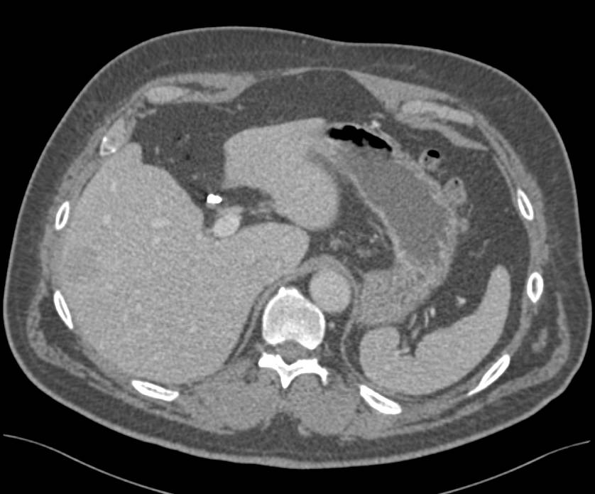 Liver Metastases from Colon Cancer - CTisus CT Scan