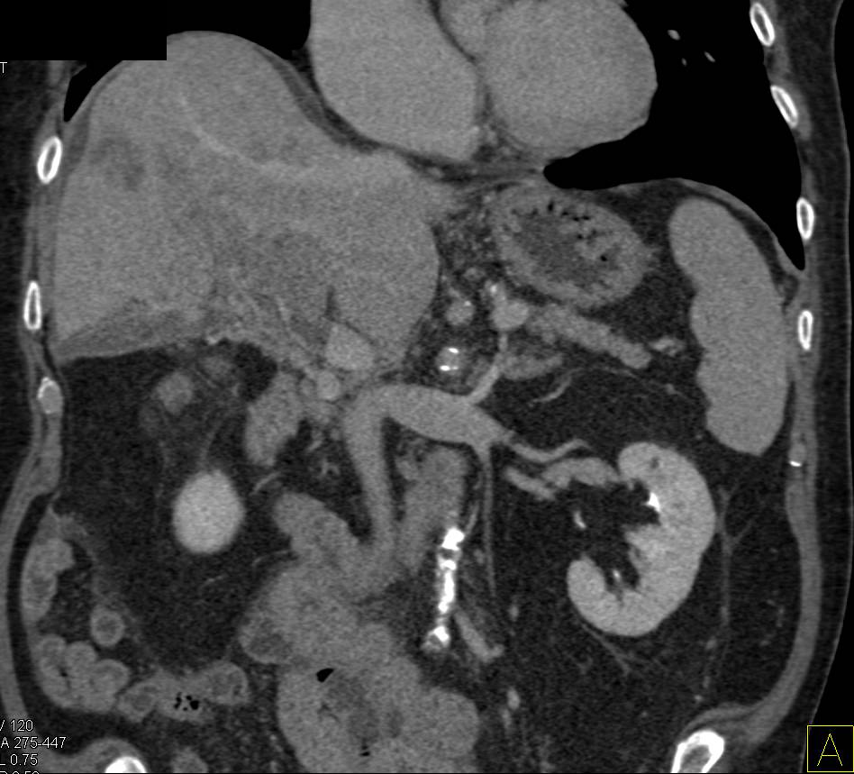 Hepatocellular Carcinoma (Hepatoma) with Vascular Invasion - CTisus CT Scan