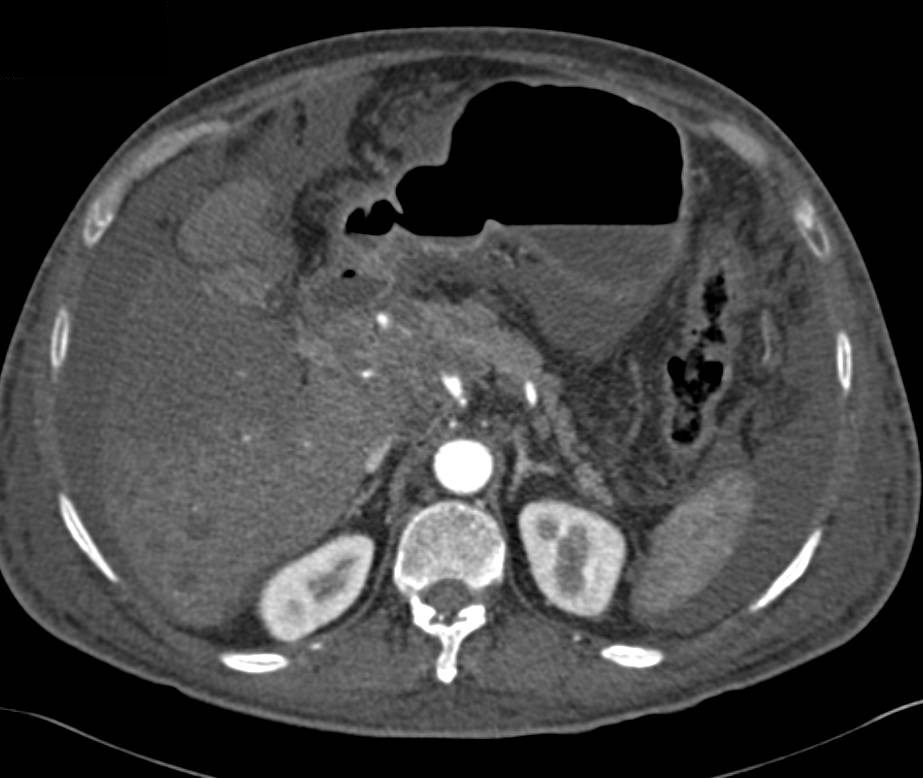 Cholangiocarcinoma Invades the Portal Vein with Adenopathy as well - CTisus CT Scan