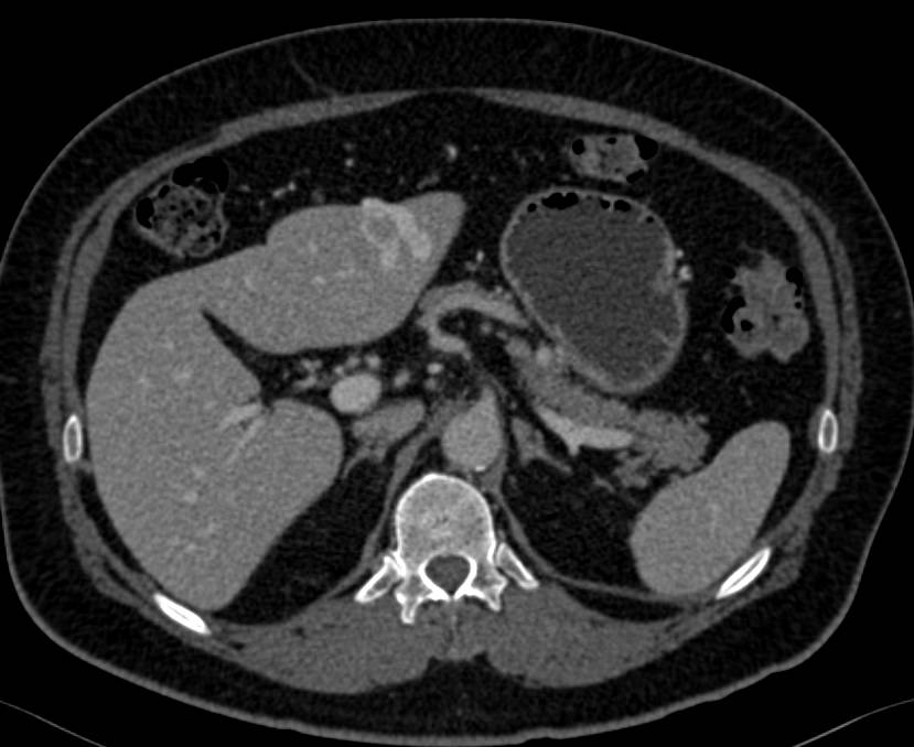 Cirrhosis with Venous Shunt Left Lobe of the Liver - CTisus CT Scan