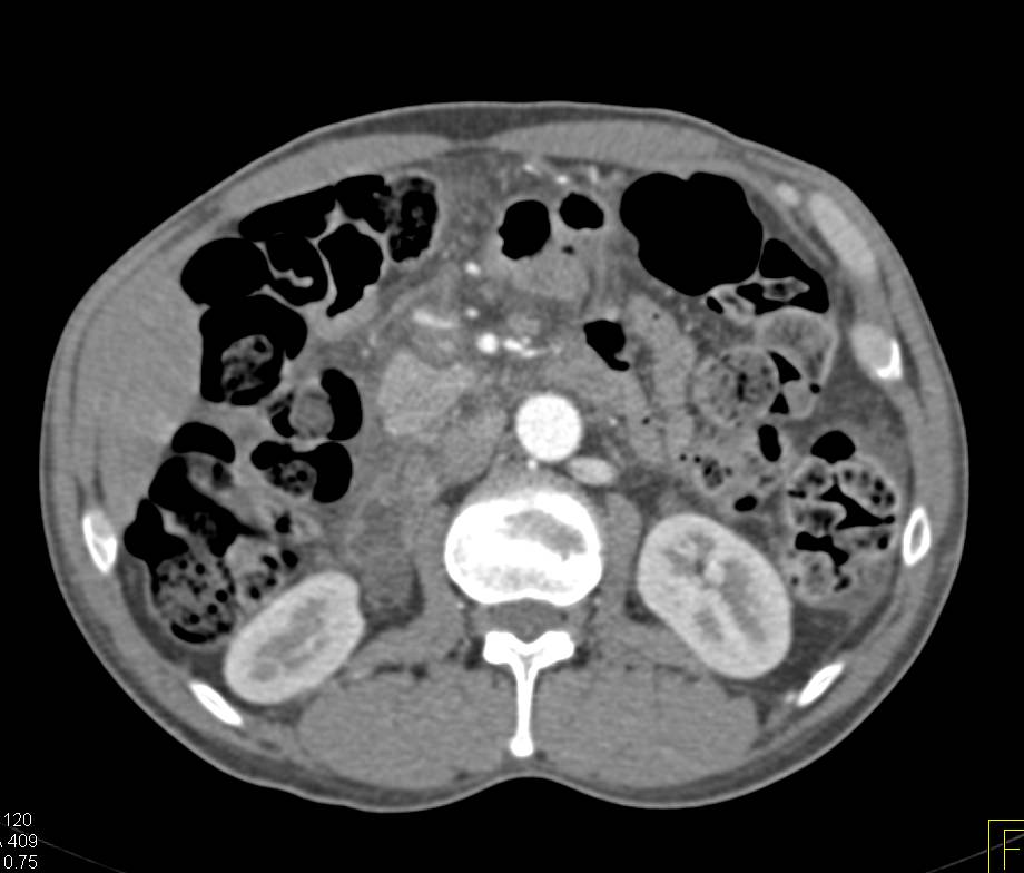 Hepatocellular Carcinoma (Hepatoma) - CTisus CT Scan