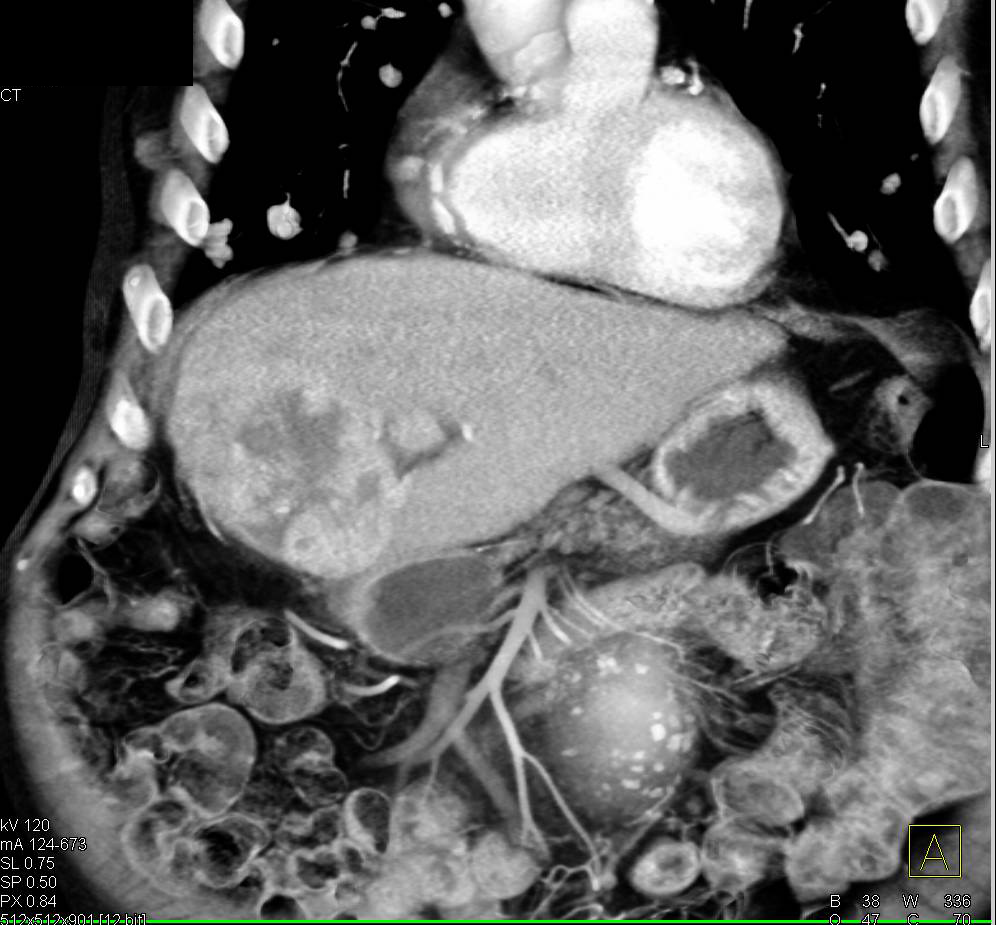 Recurrent Hepatocellular Carcinoma (Hepatoma) with Right Adrenal and Lung Metastases - CTisus CT Scan