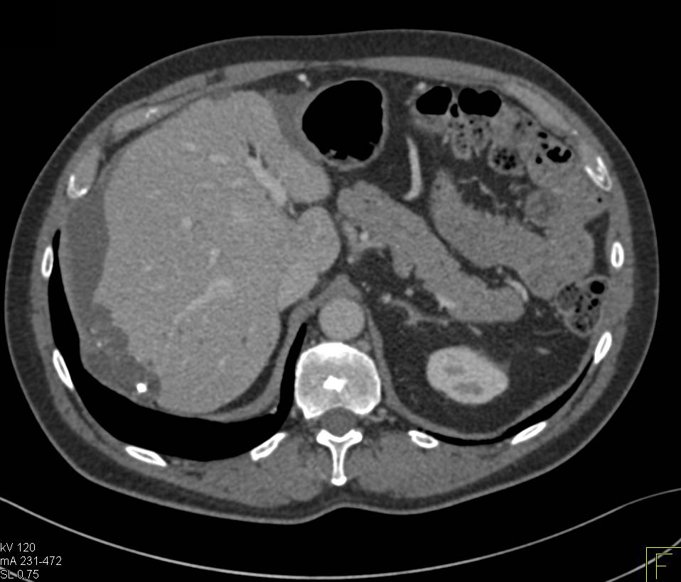 Implants on Liver from Ovarian Cancer - CTisus CT Scan