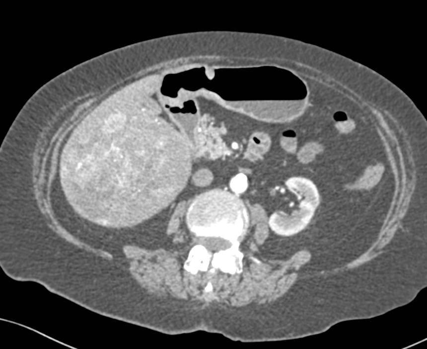 Multifocal Hepatocellular Carcinoma (Hepatoma) with Neovascularity - CTisus CT Scan