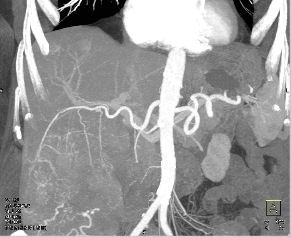 Heptoma with Neovascularity Nicely Defined - CTisus CT Scan