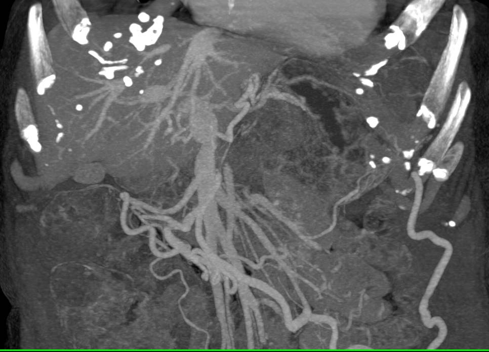 Cirrhosis with Vascular Collaterals - CTisus CT Scan