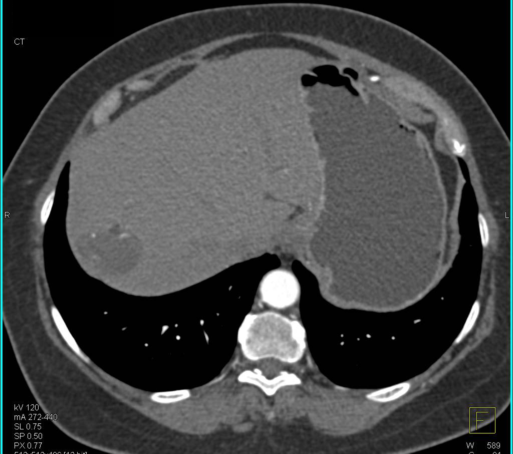 Cystic Lesion with Calcification was an Old Abscess - CTisus CT Scan