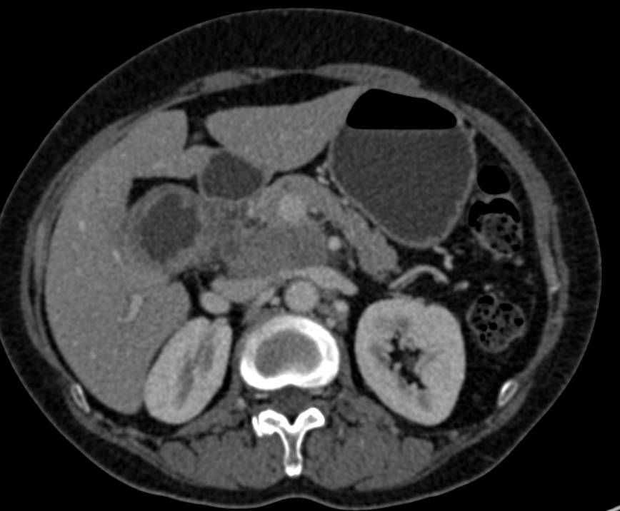 Gallbladder Cancer with Bulky Peripancreatic Adenopathy - CTisus CT Scan