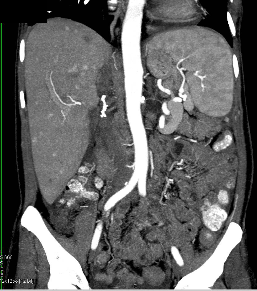 Metastatic Renal cell carcinoma to the Liver (Miliary Lesions) - CTisus CT Scan