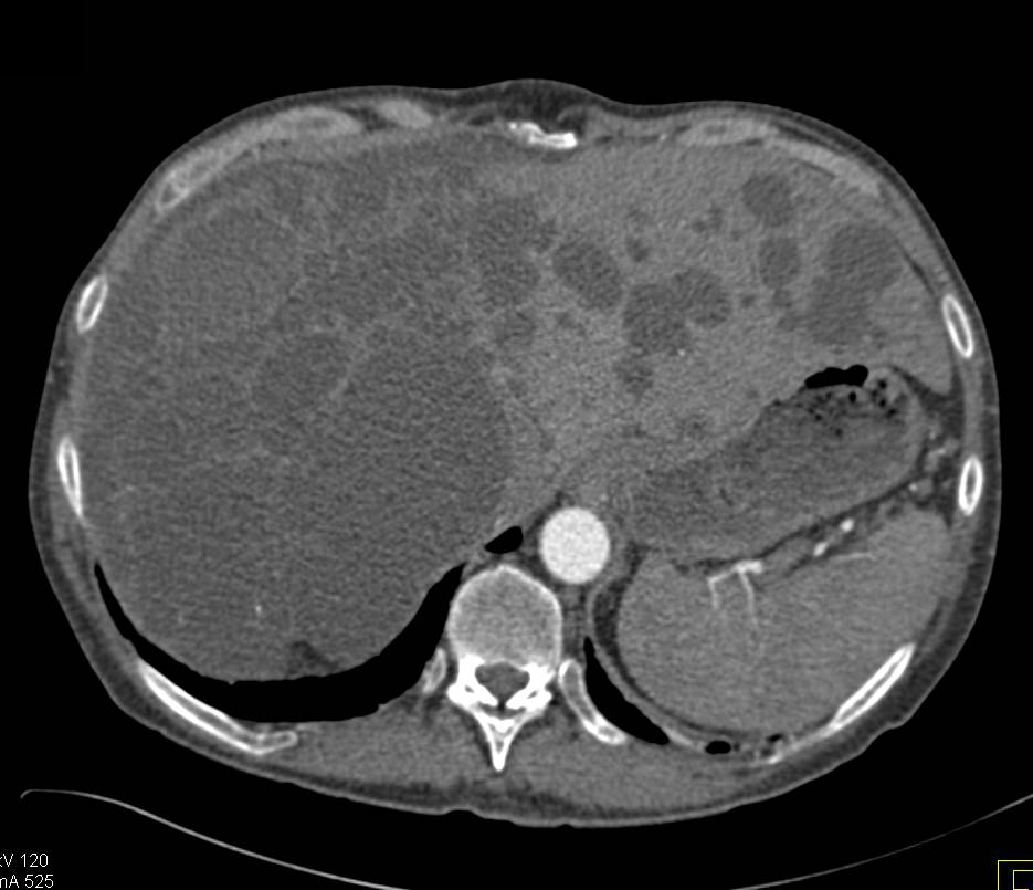 Polycystic Liver and Renal Disease  (PCLD and PCKD) - CTisus CT Scan