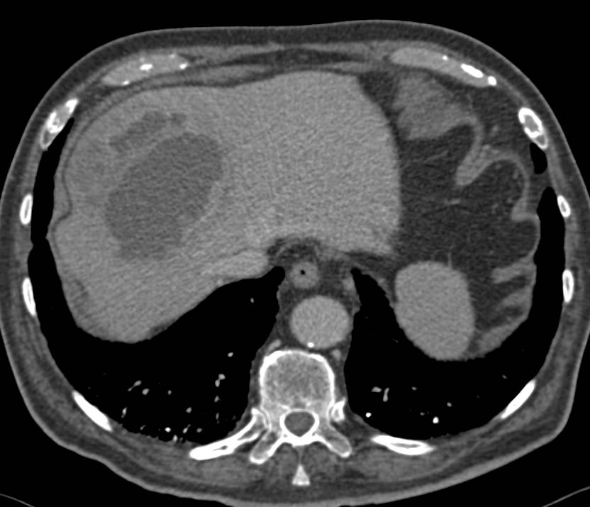 Liver Abscess - CTisus CT Scan