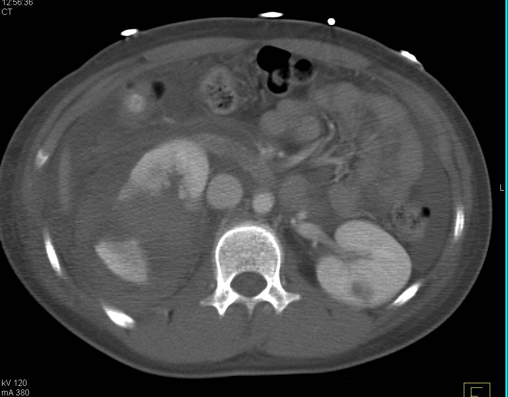 Renal and Liver Laceration with Hemoperitoneum - CTisus CT Scan