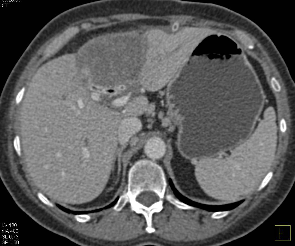 Cholangiocarcinoma Invades the Left Portal Vein - CTisus CT Scan