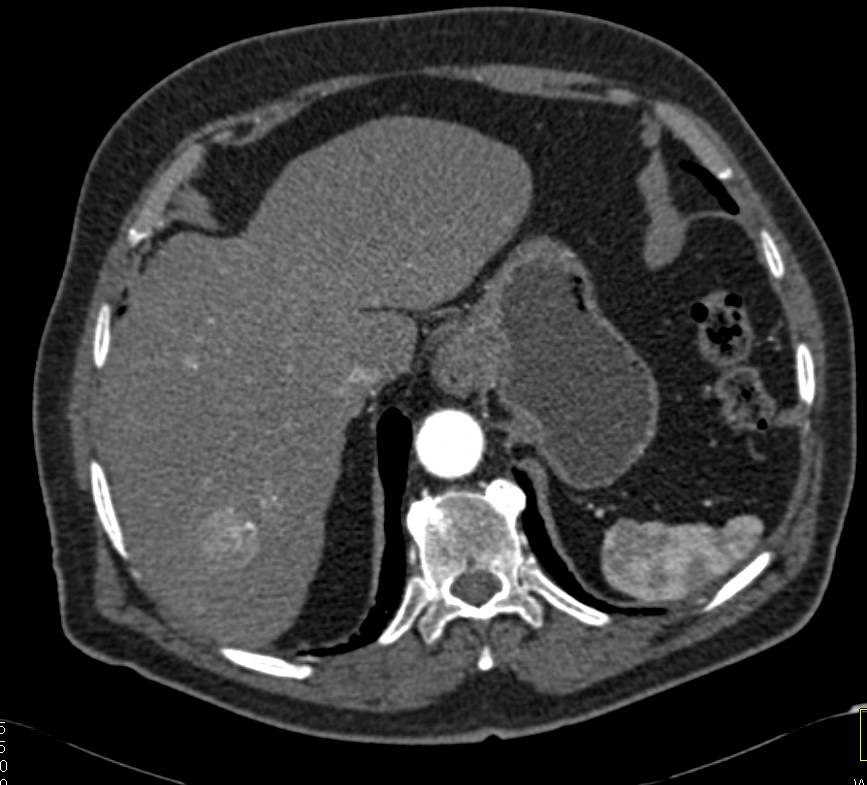 Hepatocellular Carcinoma (Hepatoma) - CTisus CT Scan