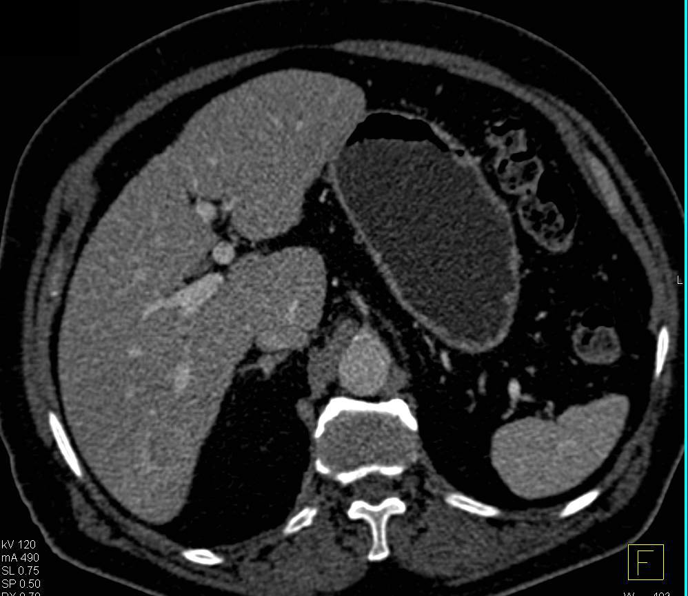 Hepatic Hemangioas - CTisus CT Scan