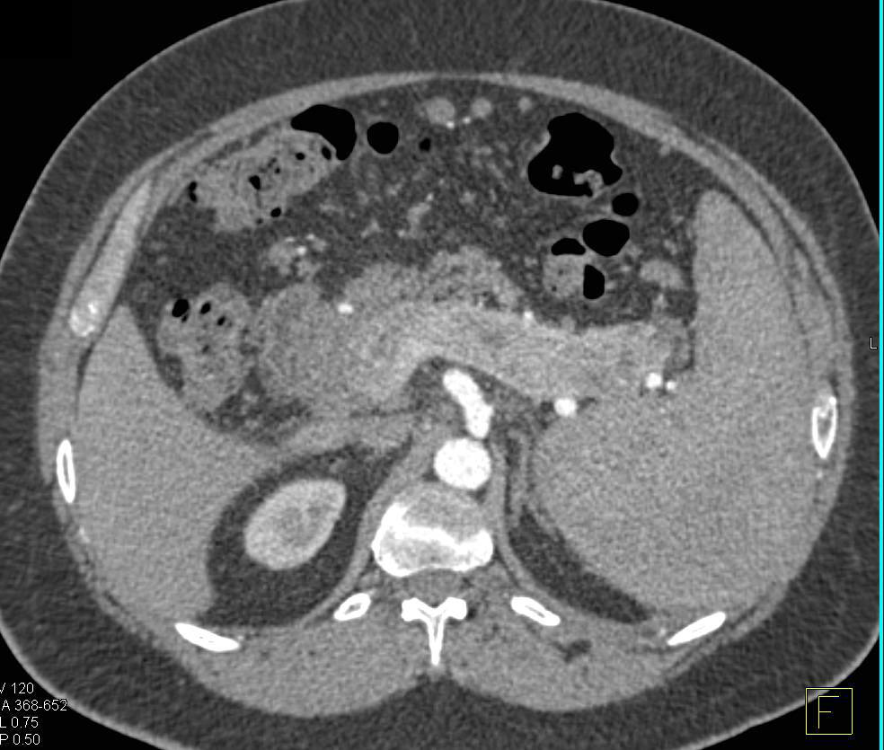 Cirrhosis with Portal Hypertension and Cavernous Transformation of the Portal Vein (CTPV) - CTisus CT Scan