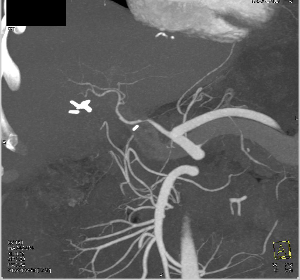 Common Hepatic Artery Stenosis in a Patient s/p Liver Transport - CTisus CT Scan