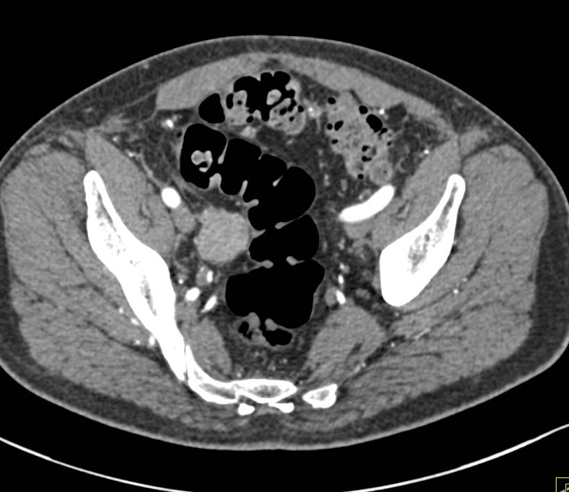 Mass in Pelvis with Liver Metastases-Probably Atypical Carcinoid - CTisus CT Scan