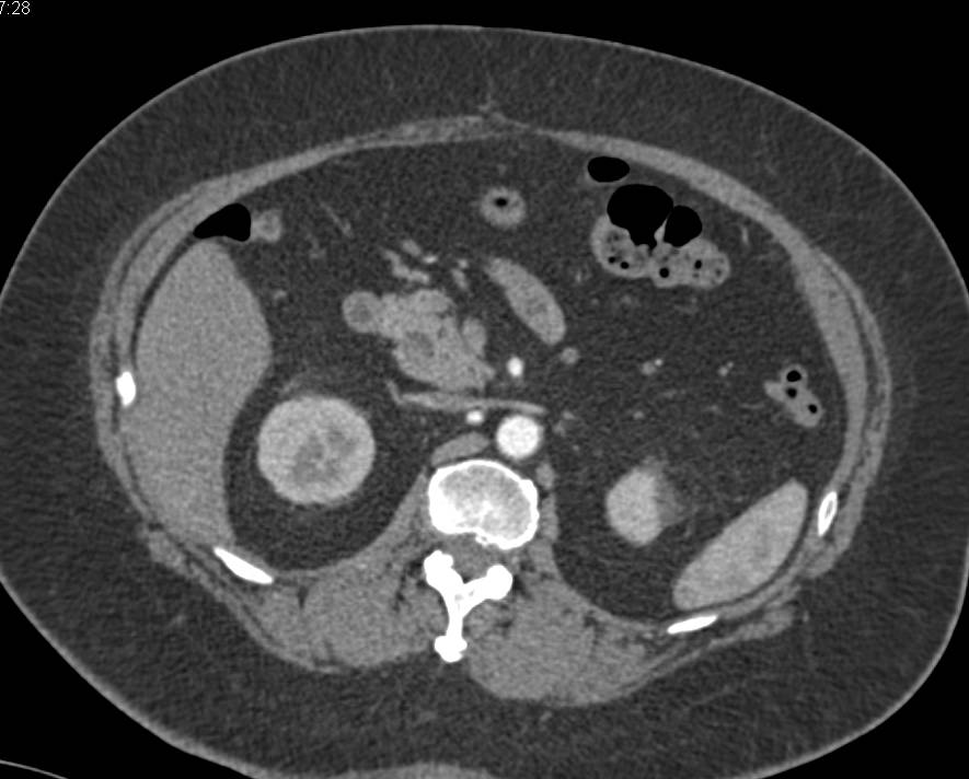 Stone in Distal Left Common Bile Duct - CTisus CT Scan