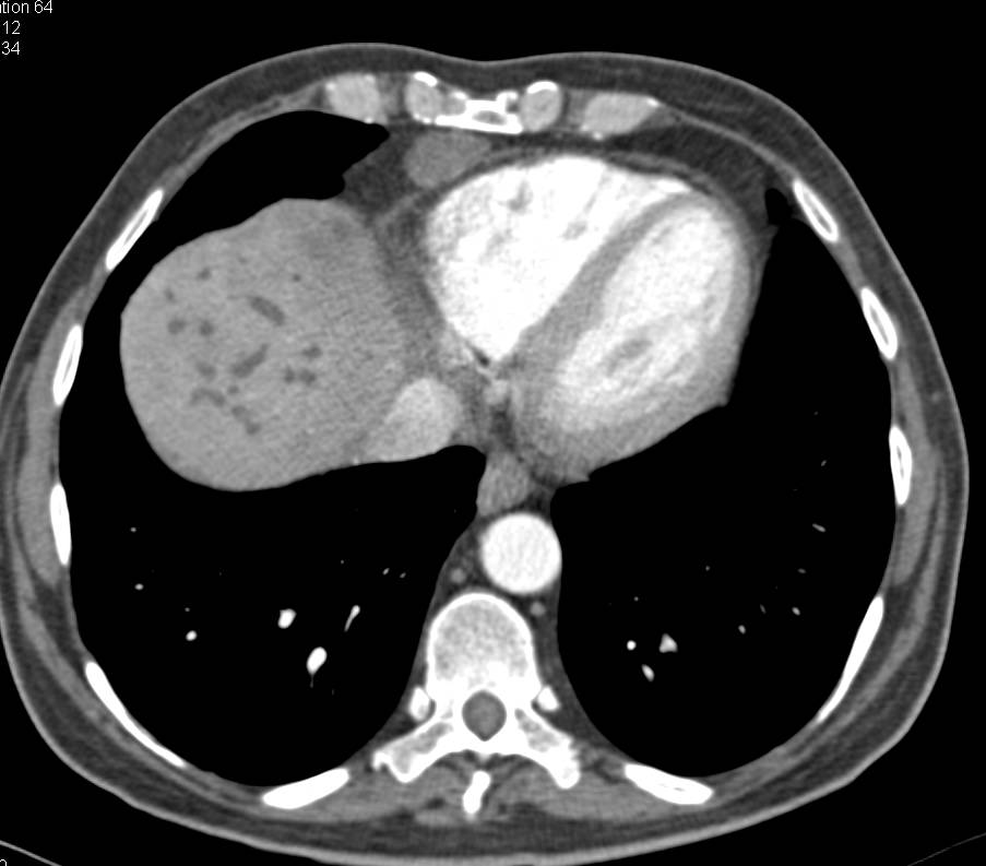 Dilated Intrahepatic Ducts and Liver Metastasis in a Patient With Pancreatic Cancer - CTisus CT Scan